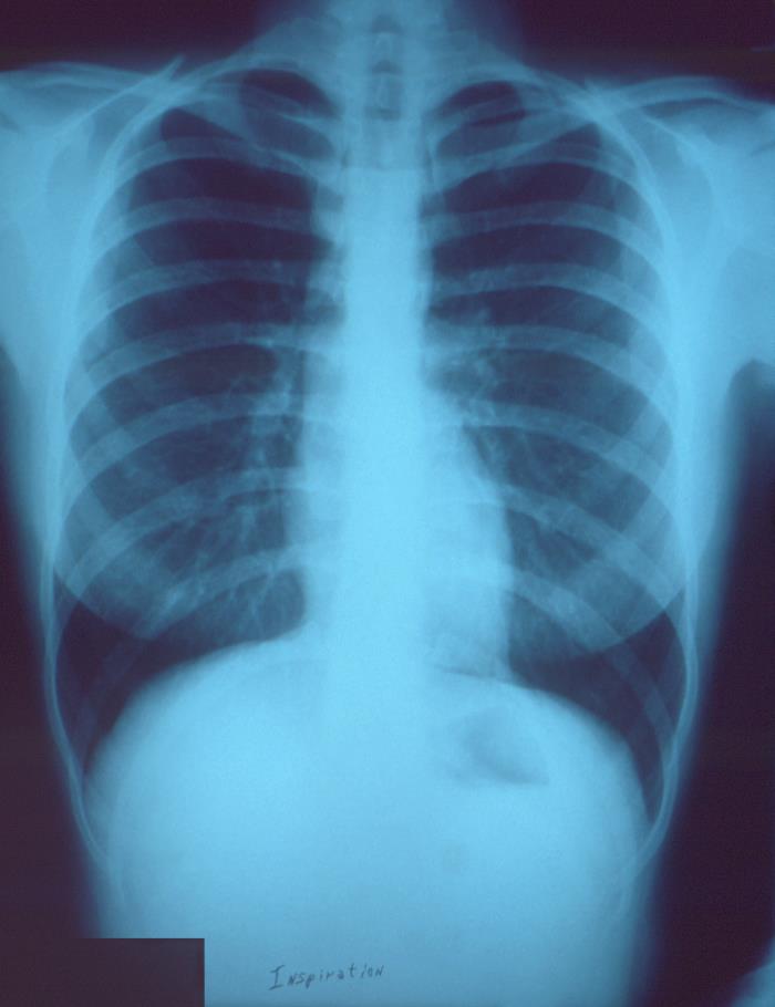 Public educational chest X-ray from the CDC Public Health Image Library, shown in full.